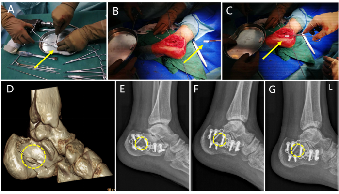 博骼列®新型含镁复合多孔支架临床使用及术后影像学评价