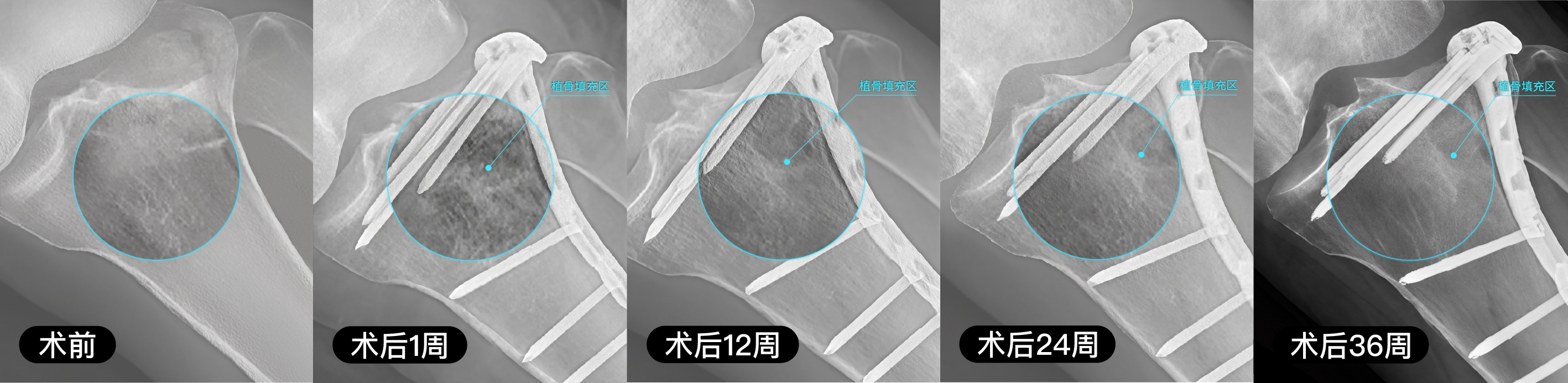 含镁可降解高分子骨修复材料