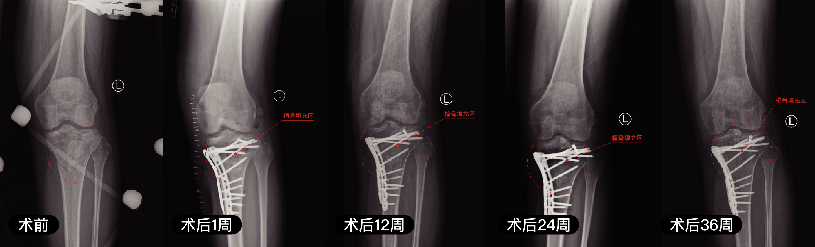 含镁可降解高分子骨修复材料