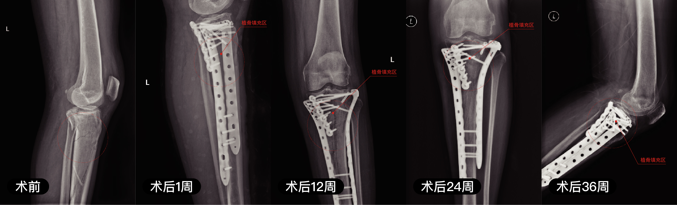 含镁可降解高分子骨修复材料